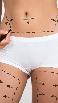 Person Hand Drawing Lines On Woman's Abdomen And Leg For Abdominal Cellulite Correction