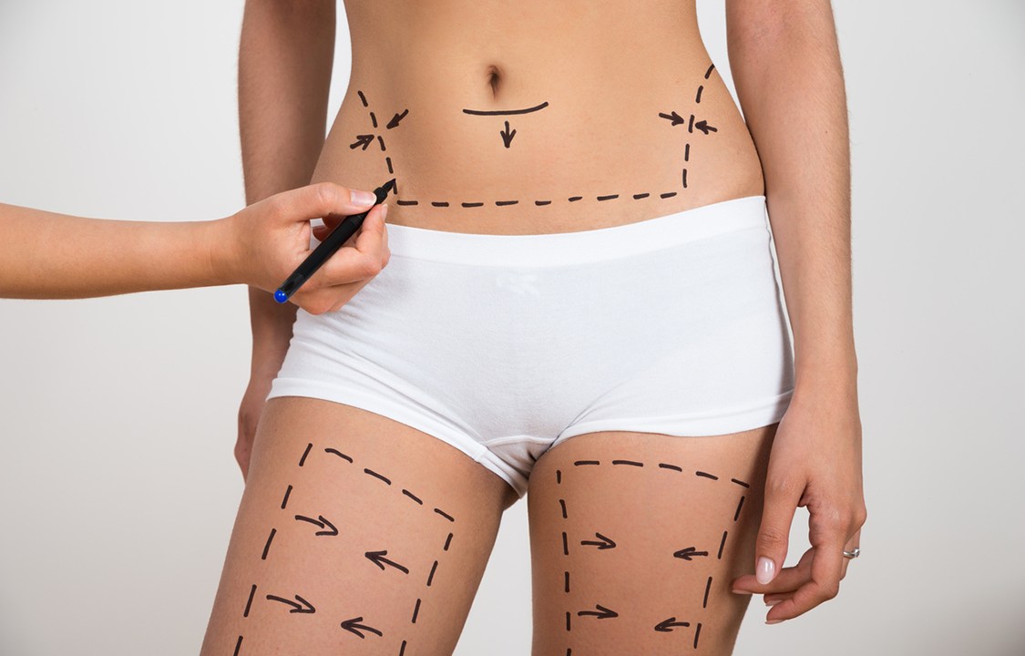 Person Hand Drawing Lines On Woman's Abdomen And Leg For Abdominal Cellulite Correction