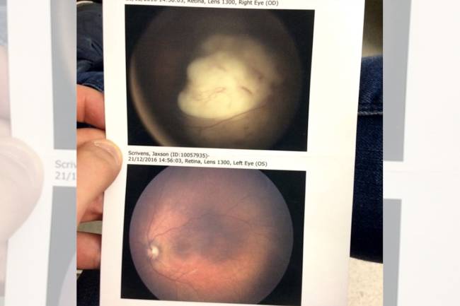 Um exame ocular comprou que Jaxson tinha retinoblastoma, um tipo raro de câncer que tem início na retina.