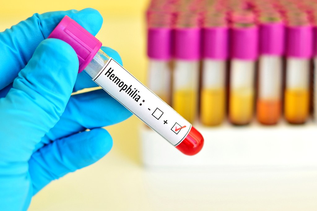 Teste positivo para hemofilia