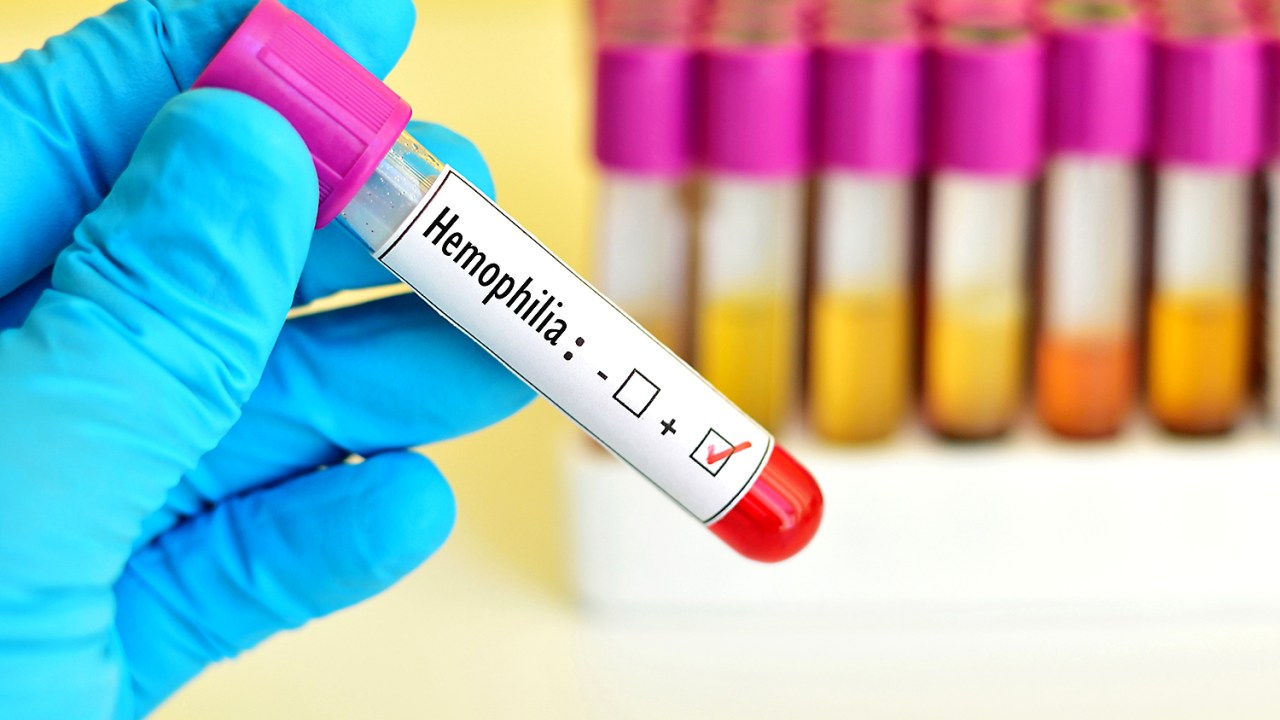 Teste positivo para hemofilia