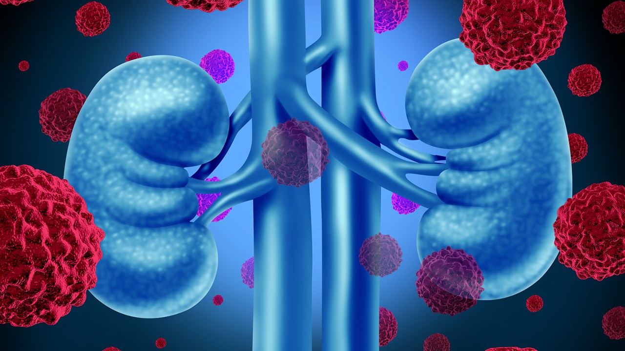 Ilustração de câncer nos rins