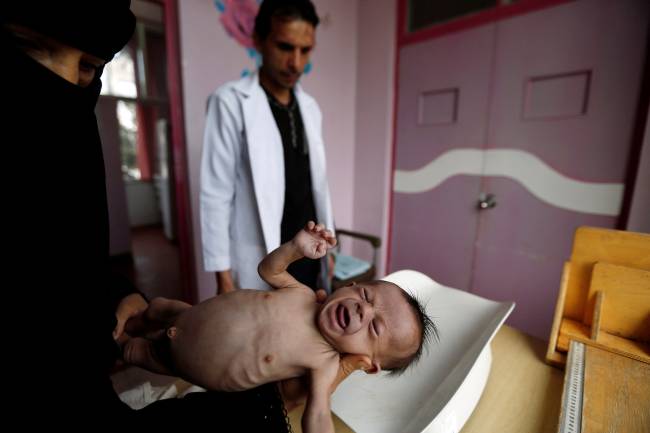 Criança com malnutrida no Iêmen