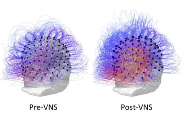 Antes (à esquerda) e depois (à direita): as cores mais quentes indicam um aumento da atividade cerebral depois da estimulação do nervo vago em regiões responsáveis por movimentos planejados, raciocínio espacial e atenção.