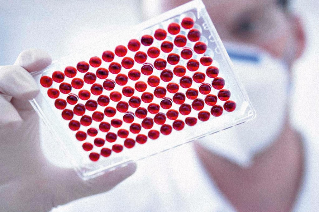 “BIÓPSIA LÍQUIDA” - Lâminas com amostras de sangue: malignidade detectada um ano antes dos exames convencionais