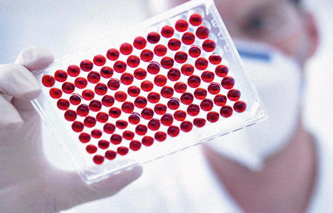 “BIÓPSIA LÍQUIDA” - Lâminas com amostras de sangue: malignidade detectada um ano antes dos exames convencionais