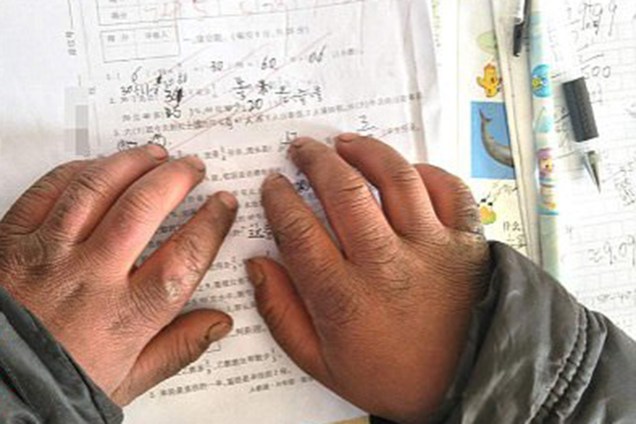 As mãos do garoto chinês Wang Fuman, que ficou conhecido como "Menino Congelado"