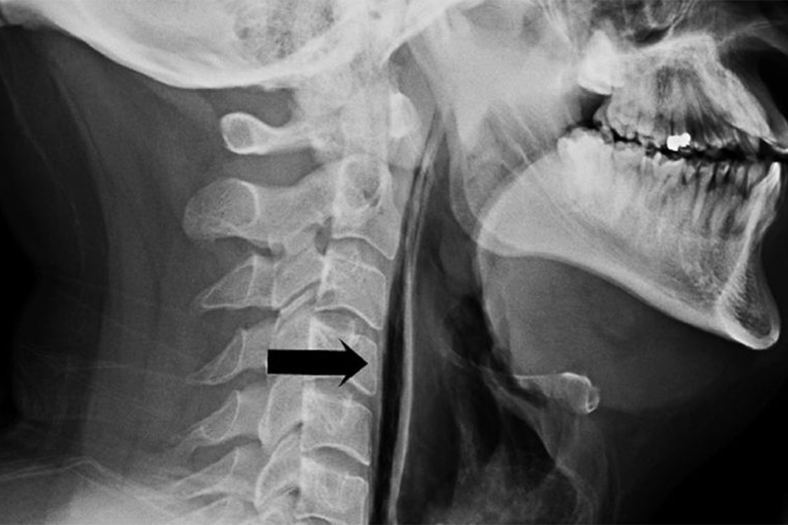 Сухой горловой. Подъязычная кость рентген. Перелом подъязычной кости рентген. Под язычная кость перелом.