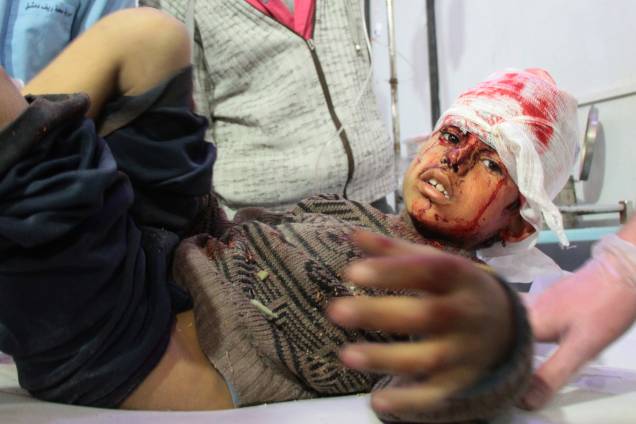 Menino ferido recebe tratamento em um hospital em Douma após ataques aéreos do governo na aldeia síria de Mesraba, na região sitiada de Ghouta Oriental, nos arredores da capital Damasco - 19/02/2018