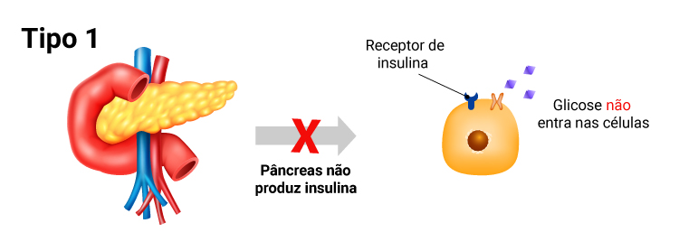No diabetes tipo 1, o pâncreas deixa de produzir insulina, o que impede que a glicose chegue às células. Desta forma, elas ficam sem ‘combustível’ para produzir energia.