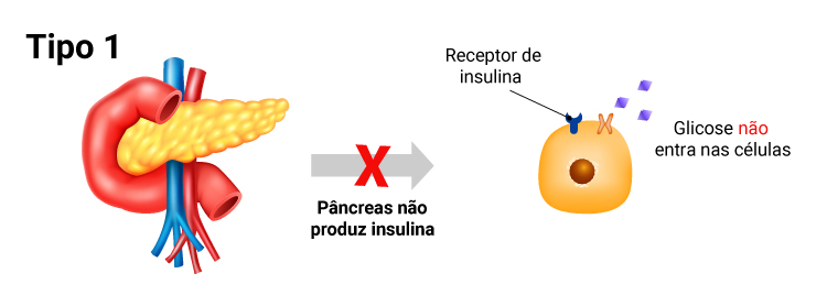 O Que é Diabetes Inaugural