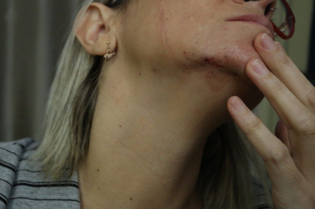 Jornalista vítima de agressão por militantes de Bolsonaro no Recife - 7/10/2018