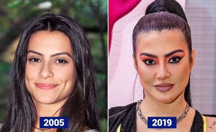 Harmonização Facial: veja o antes e depois das famosas que fizeram
