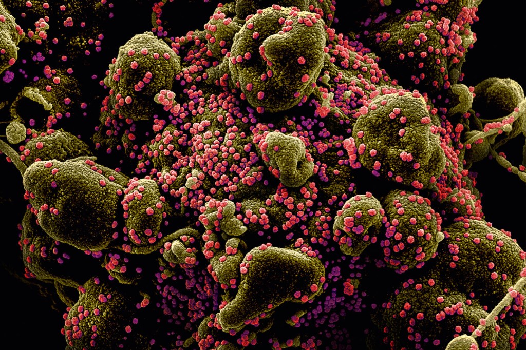 Imagem microscópica feita por pesquisadores americanos mostra a ação do sars-cov-2 (em vermelho), a nova cepa de coronavírus, agredindo células normais do organismo: jovem morreu na capital paulista