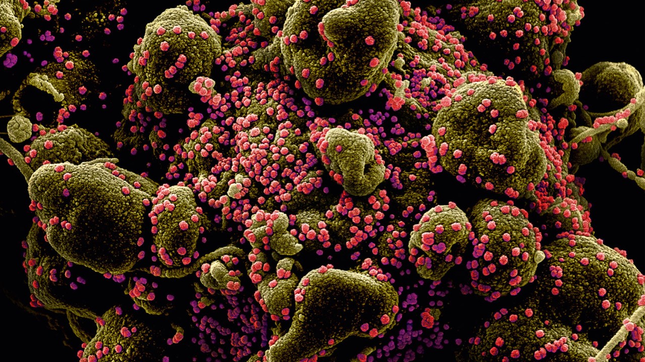 Imagem microscópica feita por pesquisadores americanos mostra a ação do sars-cov-2 (em vermelho), a nova cepa de coronavírus, agredindo células normais do organismo: jovem morreu na capital paulista