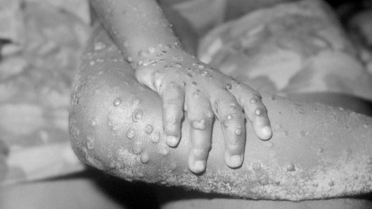 Monkeypox, A Member Of The Orthopox Family Of Viruses, Is An Infection Accidentally Transmitted To Humans Due To Its Similarity To The Smallpox Virus. Although Animals Infected With Monkeypox Exhibit No Symptoms, Infected Humans Manifest High Fever Accompanied By Headaches, Cervical And Inguinal Adenopathy, And Cutaneous Lesions That Are Similar To Those That Characterize A Smallpox Infection. As With Smallpox, No Effective Medical Treatment Has Been Identified. Here, The Arms And Legs Of A 4 Year Old Girl Infected With Monkeypox. Bondua, Grand Gedeh County, Liberia. (Photo By BSIP/UIG Via Getty Images)