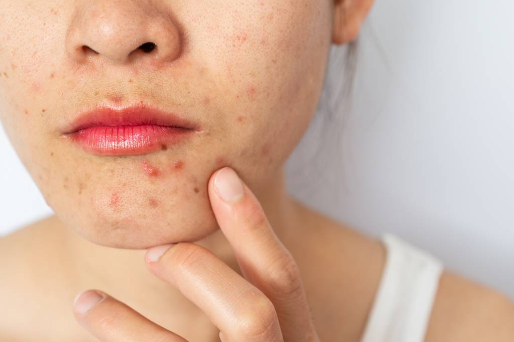 Não é só na adolescência: acne afeta mulheres até na menopausa