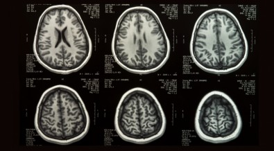 Ferramenta poderá ajudar a identificar alterações cerebrais ligadas a doenças como Alzheimer e Parkinson