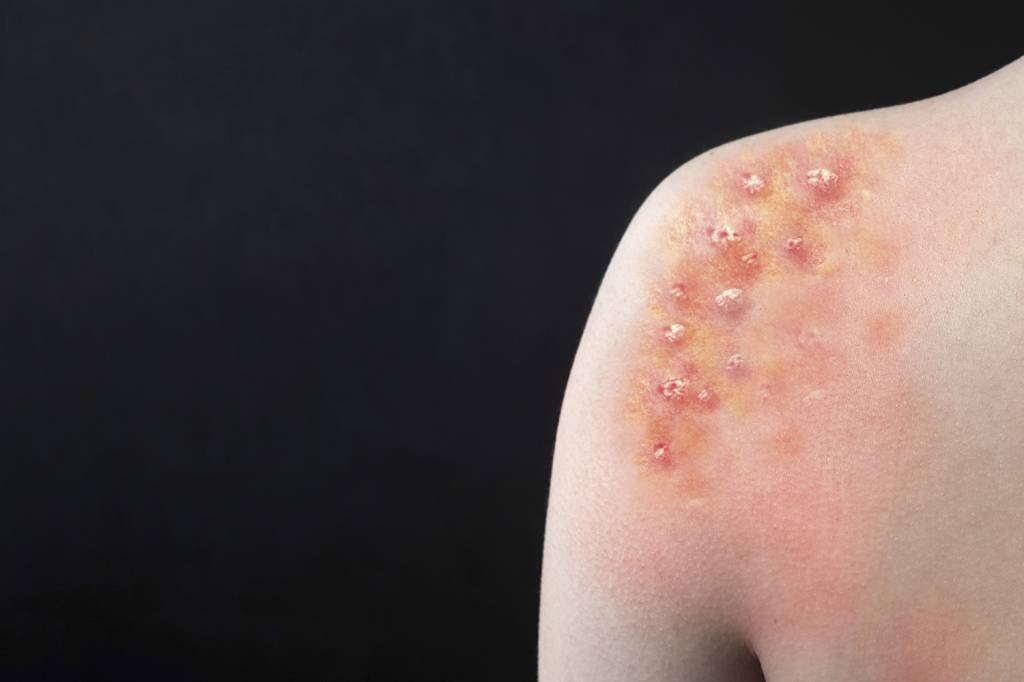 Mpox continua como emergência de saúde global, decide OMS