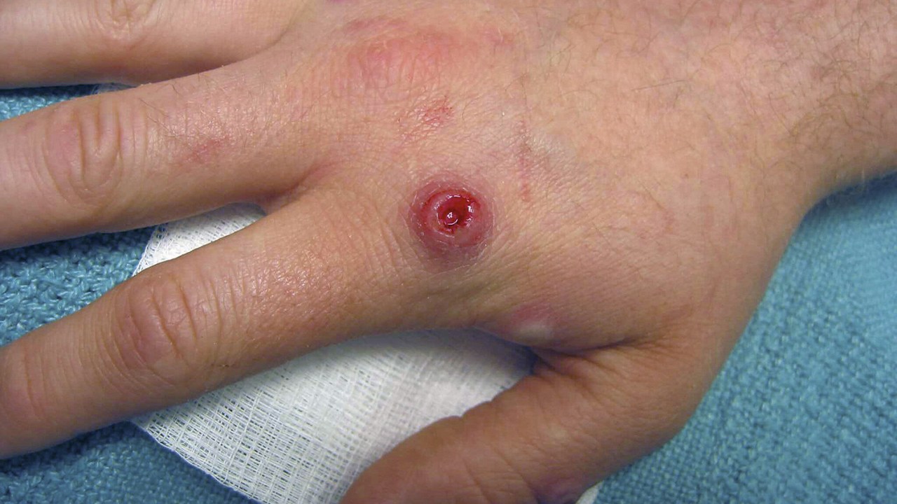 MARCAS - Lesões nas extremidades: características comuns da doença -