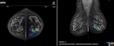 Plataforma identifica e classifica automaticamente anomalias e lesões no tecido mamário