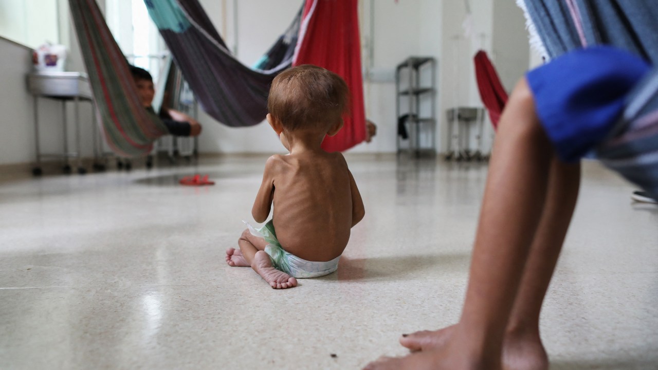 A malnourished Yanomami indigenous toddler is seen on treatment inside a ward dedicated to indigenous people of the Santo Antonio Children's Hospital in Boa Vista, Roraima state, Brazil, on January 27, 2023. - At a hospital in the Brazilian Amazon, Yanomami children convalesce on hammocks. The cases of malnutrition and child malaria in this indigenous ethnic group skyrocketed, prompting the government to declare a health emergency. (Photo by MICHAEL DANTAS / AFP)
