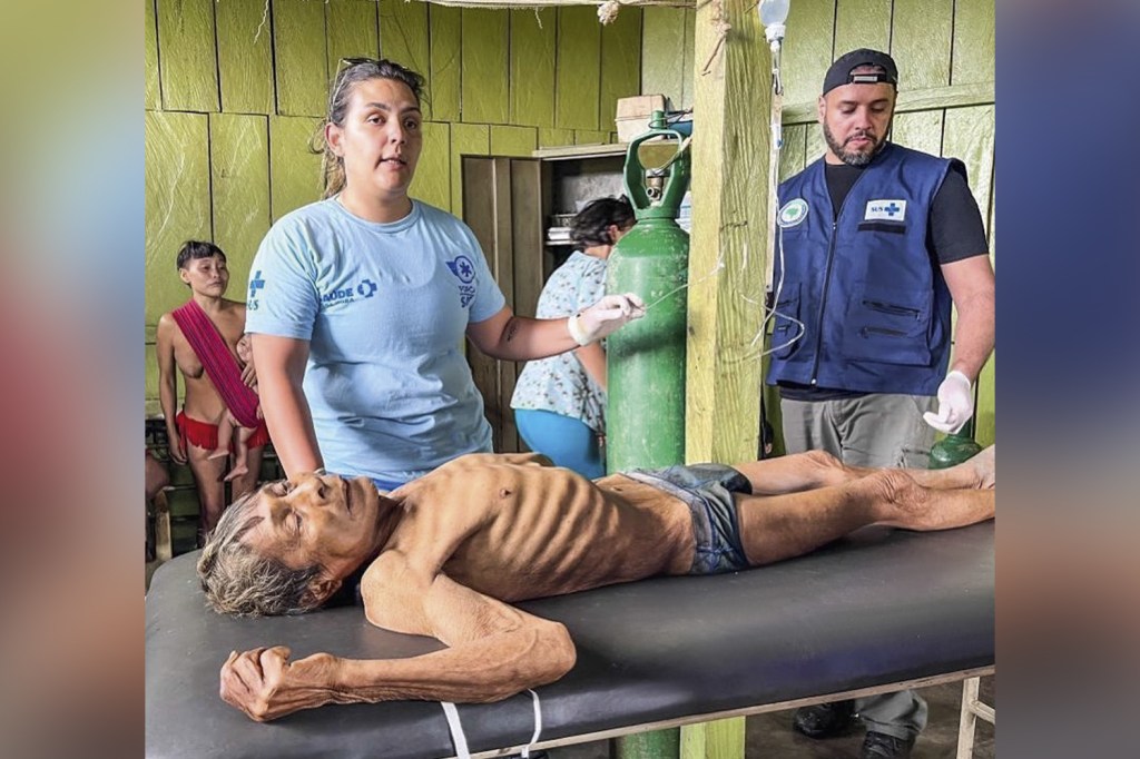 HORROR - Indígena com desnutrição em Roraima: imagens chocaram o país e correram mundo -