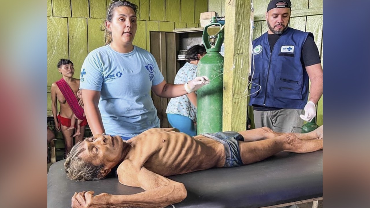HORROR - Indígena com desnutrição em Roraima: imagens chocaram o país e correram mundo -