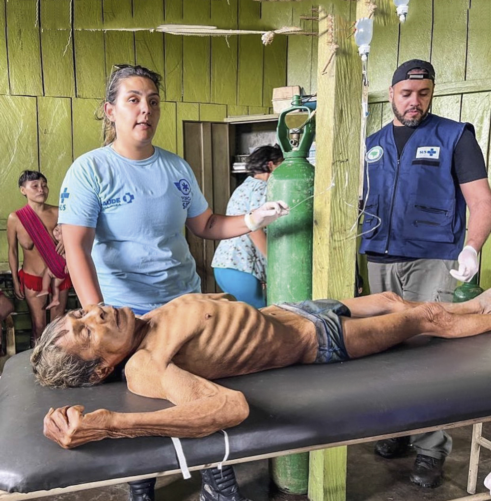 HORROR - Indígena com desnutrição em Roraima: imagens chocaram o país e correram mundo -