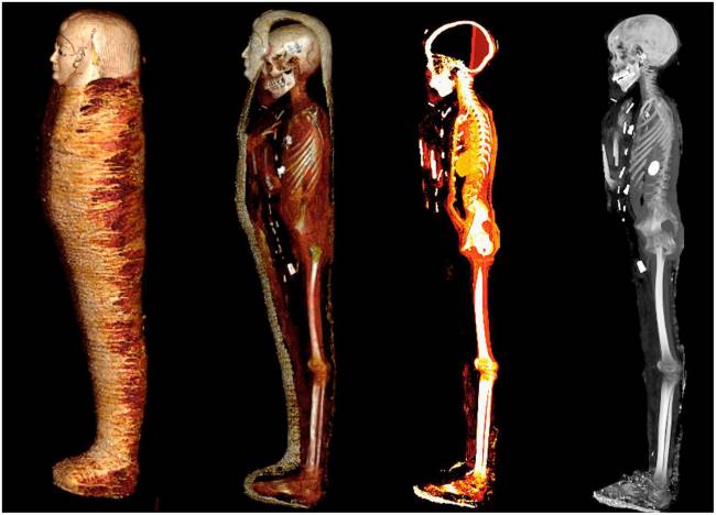 fmed-09-1028377-g002 Imagem computadorizada da múmia de um adolescente; o corpo mumificado, de 2.300 anos de idade, foi encontrado em 1913 e nunca antes estudado -