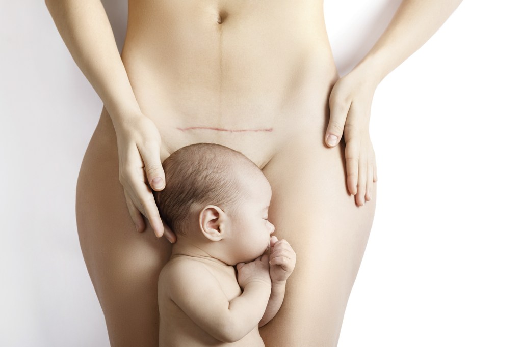 MOMENTO DELICADO - Mãe e bebê: 1 milhão nasceram via cesáreas no último ano -