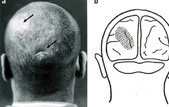 Os estudos do paciente M levaram a descobertas sobre lesões cerebrais: a) As setas indicam cicatrizes da entrada e saída do projétil que causou a lesão do paciente M; b) as áreas sombreadas mostram as prováveis ​​áreas de lesões no cérebro -