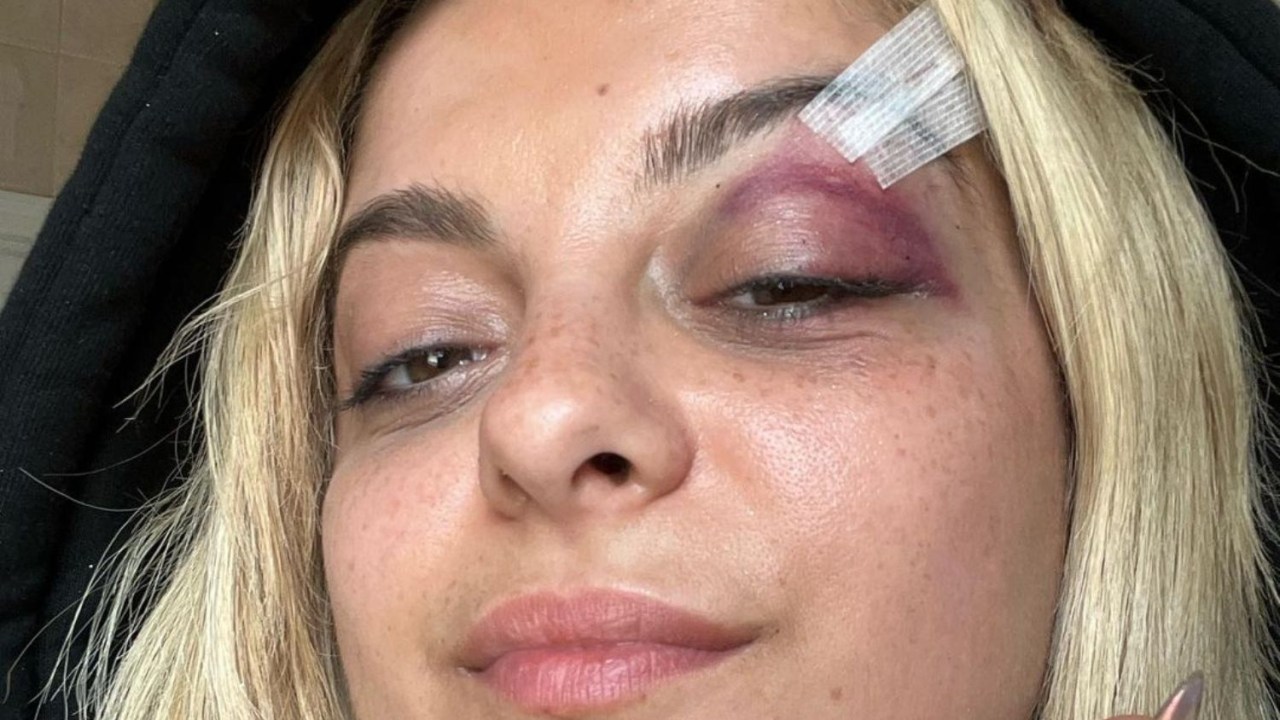 O curativo da cantora Bebe Rexha após ataque em show