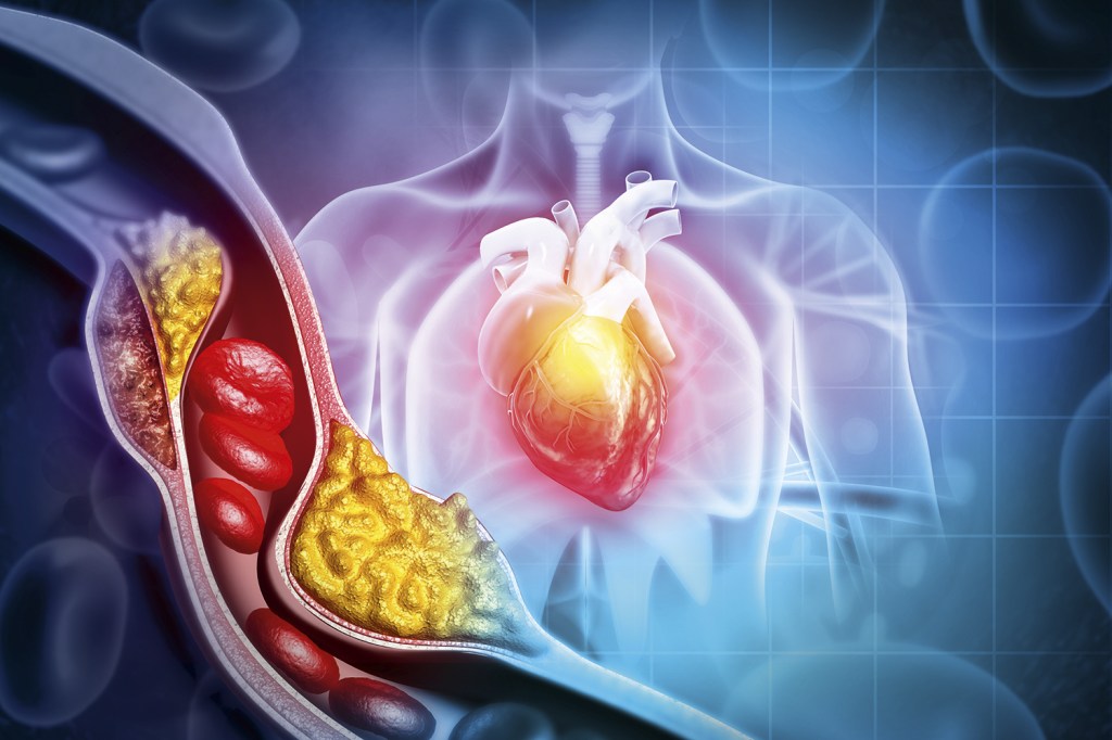 EFEITO MORTAL - Obstrução de vaso: a gordura forma as placas que cortam o fluxo de sangue para o coração