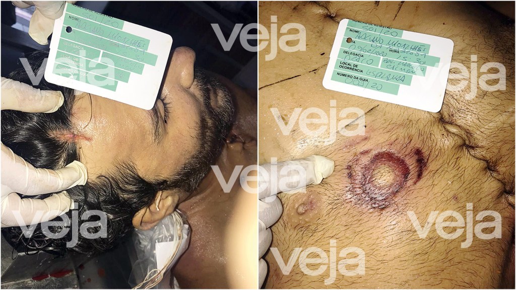 FERIDAS - O corte na cabeça e a estranha queimadura no tórax do ex-policial alimentaram a tese de tortura e execução
