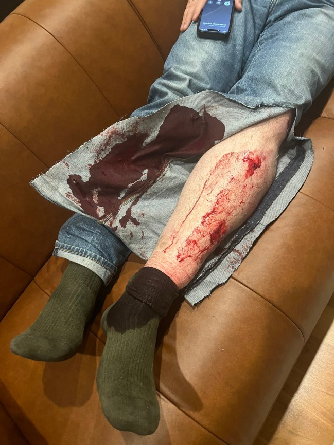 In this handout picture posted on the X account (formerly known as Twitter) of Leonid Volkov's wife Anna Biryukova @a_biryukova on March 12, 2024 shows Leonid Volkov's wounds after he was attacked outside his home in Vilnius. (Photo by Courtesy of X user @a_biryukova / AFP) / RESTRICTED TO EDITORIAL USE - MANDATORY CREDIT 