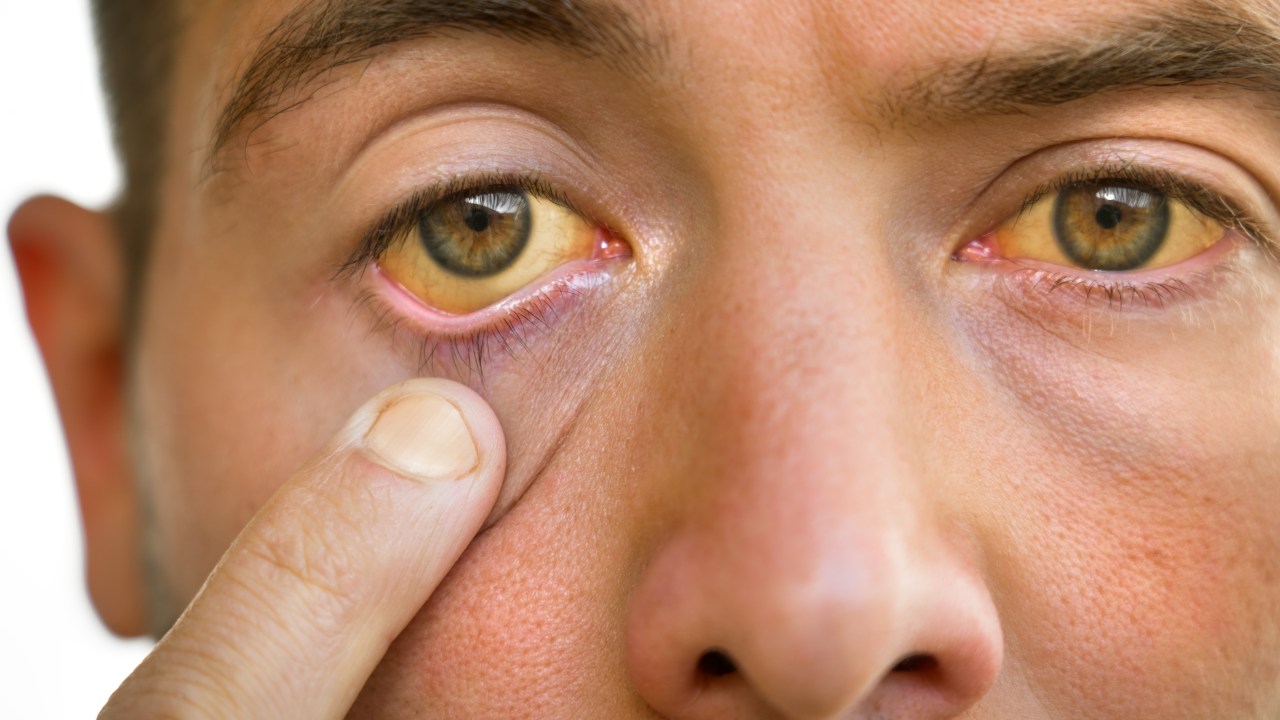 olho - olhos - fígado - doença hepática
