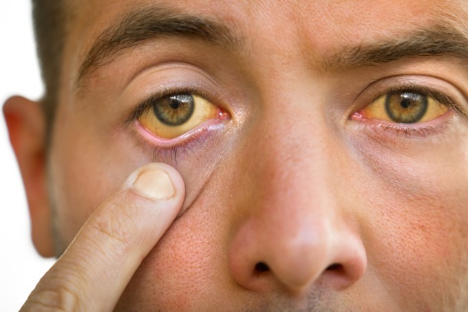 olho – olhos – fígado – doença hepática