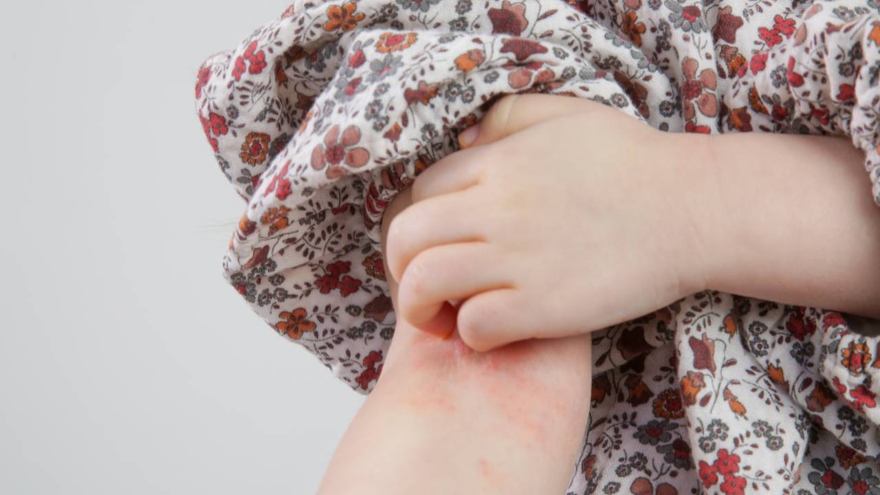 COCEIRA SEVERA: interrompe o sono das crianças com dermatite atópica e obriga os pais a acordarem frequentemente durante a noite