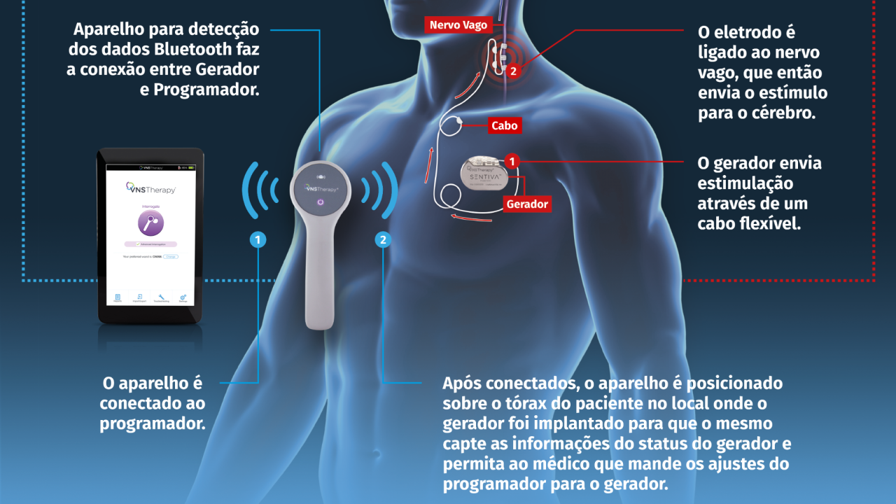 TERAPIA DE ESTIMULAÇÃO DO NERVO VAGO (VNS): judicialização do tratamento tem consequências financeiras significativas para o SUS que continua arcando com os custos indiretos das internações e dos atendimentos emergenciais.