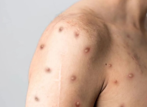 Mpox: primeiro caso de nova cepa em SP