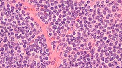 linfoma-celula-manto