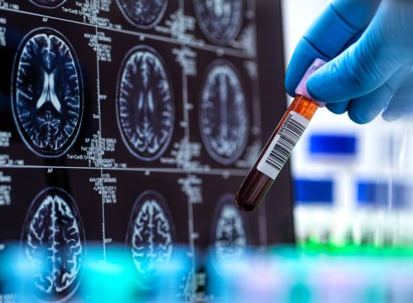 ALZHEIMER - Exame: teste brasileiro ajuda a primorar diagnóstico