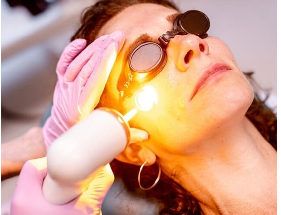 Laser amarelo: pele linda e sem dor