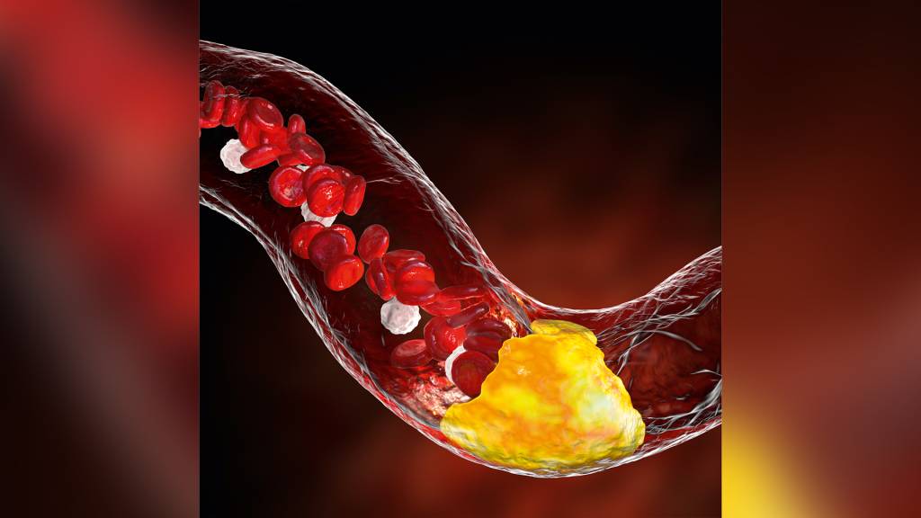 O ‘colesterol amaldiçoado’: entenda o novo risco ao coração