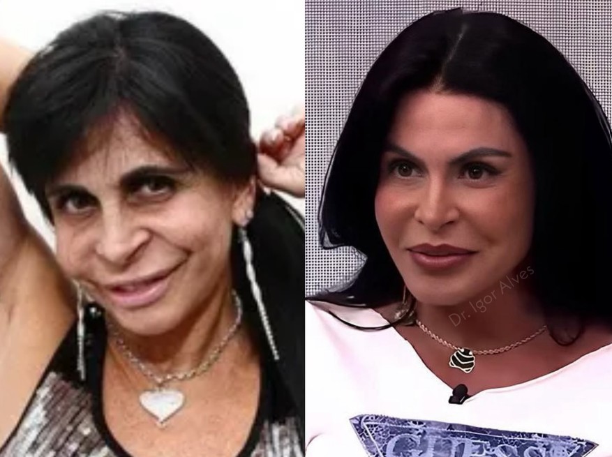 Médico faz comparação com antes e depois de cirurgias no rosto de Gretchen