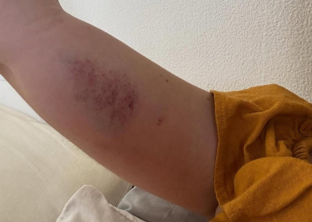 Machucado no braço de Marcela