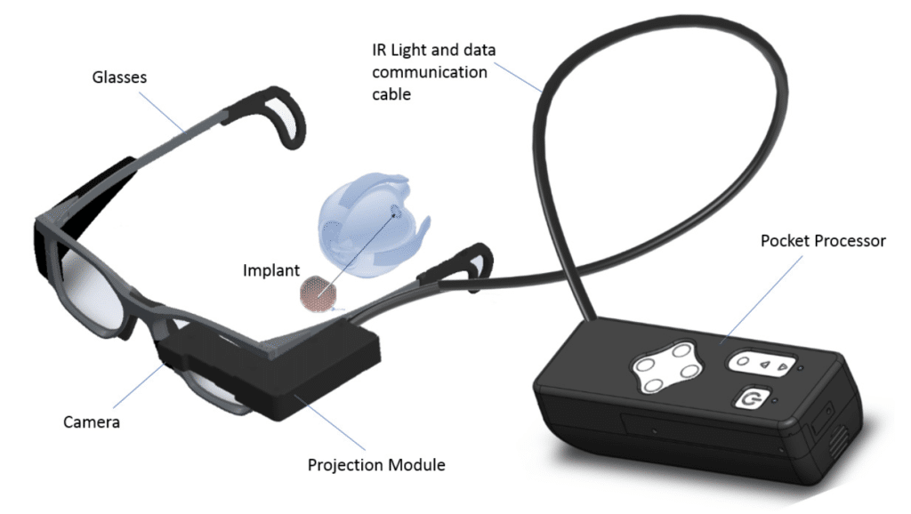 recuperacao-cegueira-implante