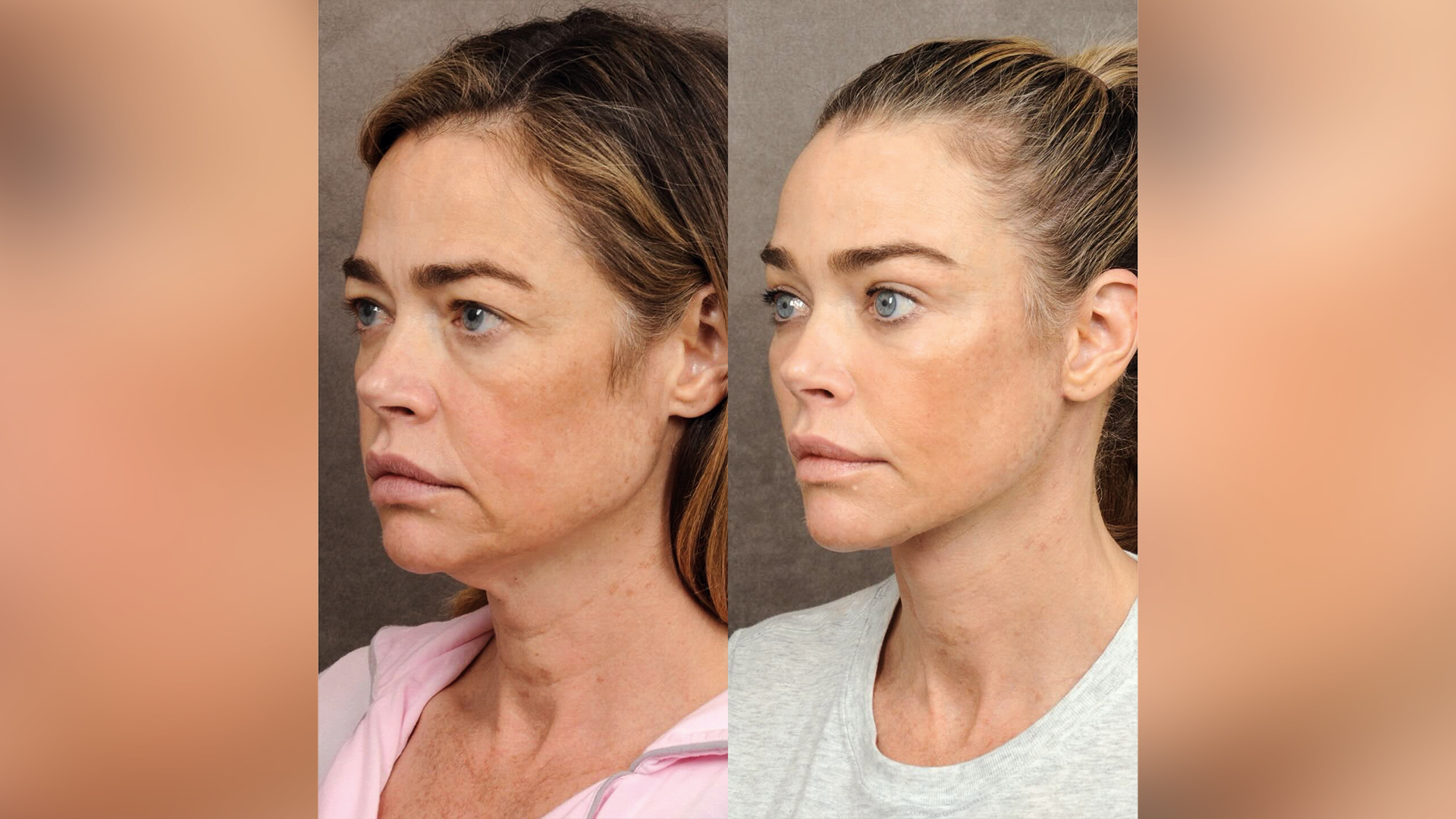 METAMORFOSE - A atriz Denise Richards, de 55 anos: combinação de técnicas como o deep plane facelift