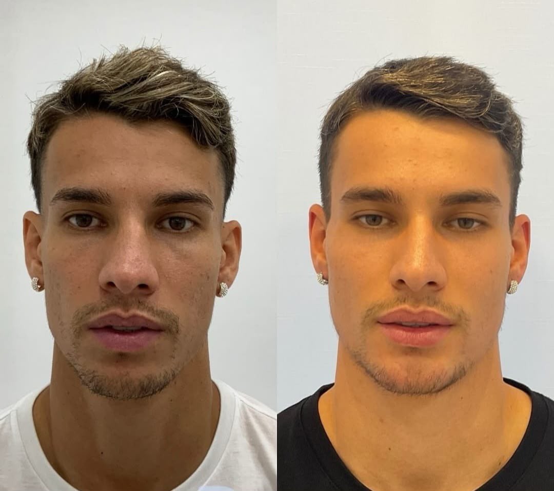 Comparativo de um homem jovem antes e depois de um procedimento est&eacute;tico. &Agrave; esquerda, ele tem cabelo castanho claro com mechas loiras, pele com sardas e barba rala. &Agrave; direita, o cabelo est&aacute; mais escuro e curto, a pele mais uniforme e a barba mais cheia, com l&aacute;bios levemente mais volumosos. Ambos usam brincos de argola prateados e camisetas lisas, uma branca e outra preta, em fundo branco